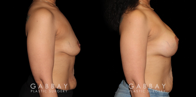 Patient with combined breast lift and breast augmentation using saline implants. Patient fully recovered from the combination procedure with excellent results.