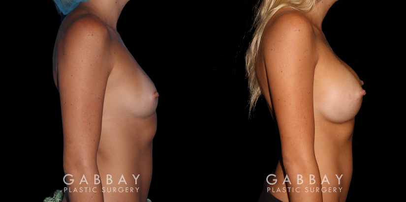 Breast augmentation before-and-after photos for patient with silicone implants. Increased volume resulted in pleasantly round breasts without excessive change.