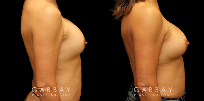 Patient before-and-after photos for implant removal and replacement procedure. This revision breast augmentation went well and patient was satisfied with how her new implants looked and felt.