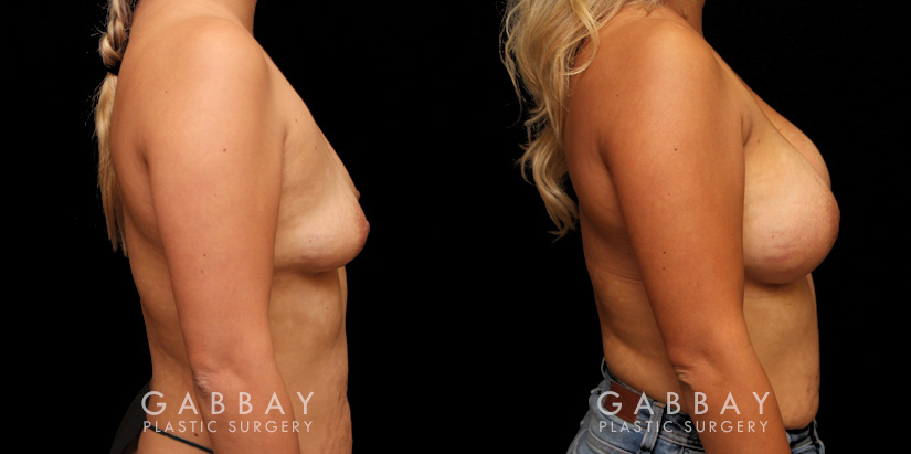 Before-and-after photos for female patient with breast augmentation. Classic results show improved size and volume of breasts with enhanced roundness from each angle.