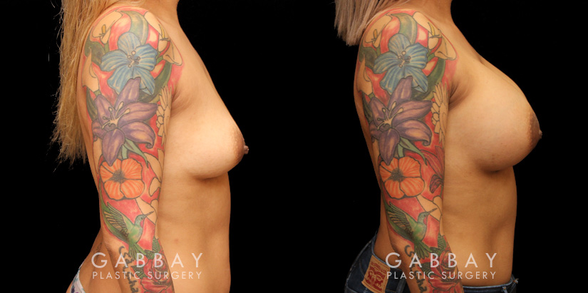 Silicone implant breast augmentation photos showing before and after the procedure (post complete recovery). Patient breasts are demonstrably rounder with a balanced volume increase that suits her body shape.