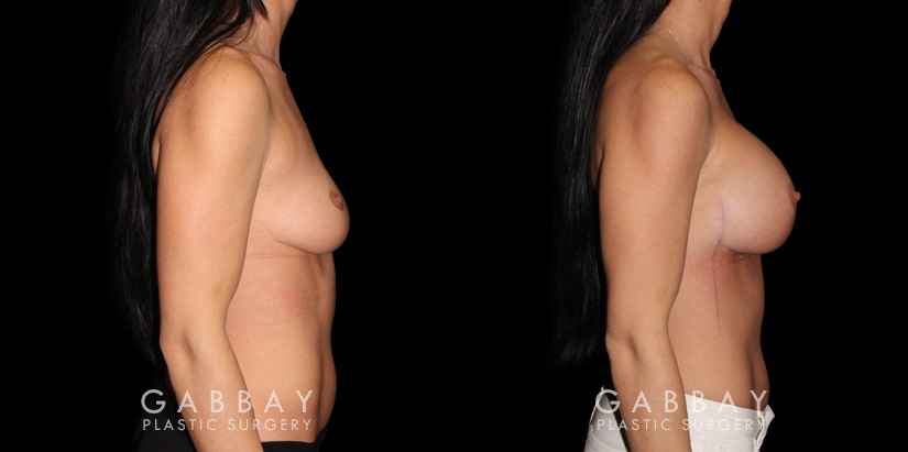 Patient breasts with silicone implants following complete recovery. Now how the incisions are hidden in the breast folds, making them invisible from most angles.