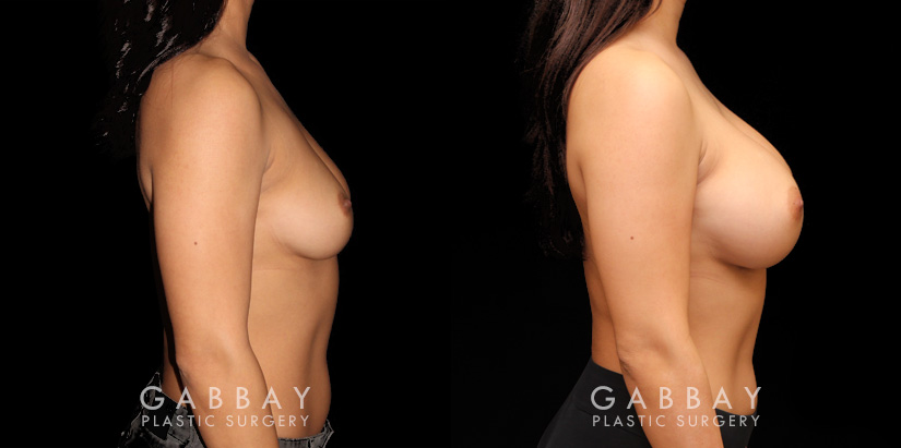 This is a breast augmentation patient who had significant asymmetry. She underwent silicone breast implant augmentation, using different sized high profile Allergan Natrelle Soft Touch implants: 365 cc on the left, 435 cc on the right. Implants were placed below the muscle in a dual plane configuration using an incision that is beautifully hidden within the breast fold.