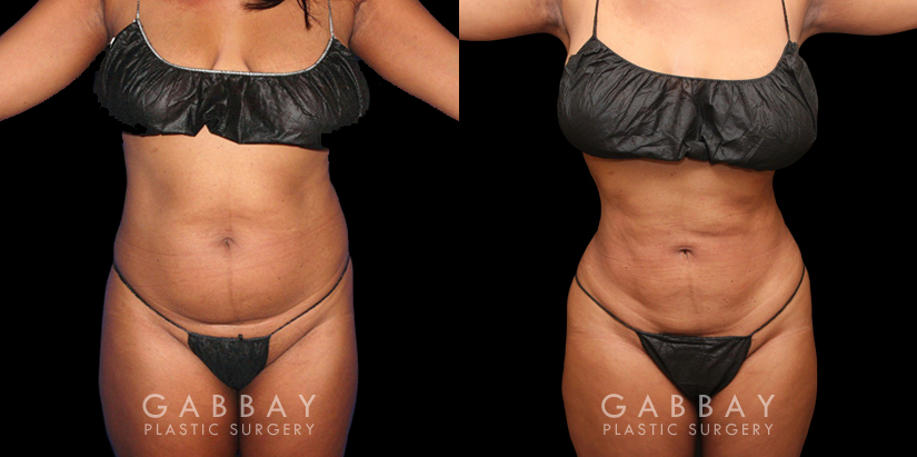 Female patient’s liposuction results, tightening her abdomen area significantly while minimizing any scarring. Patient recovered without complications and enjoyed an enhanced visibility of her natural curvy contours.