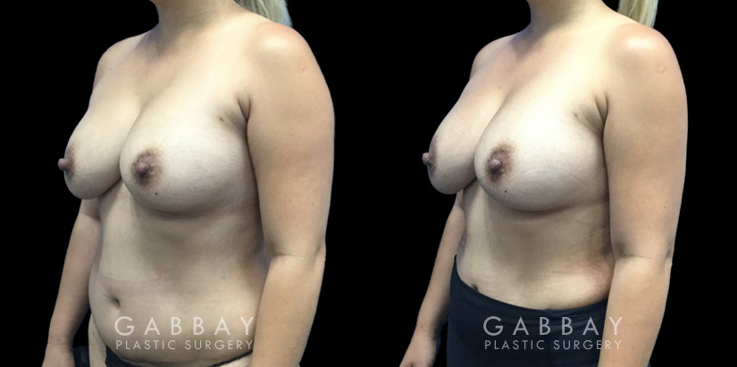 Patient 13 3/4th Left Side View Breast Fat Grafting Gabbay Plastic Surgery