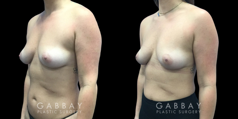 Patient 14 3/4th Left Side View Breast Fat Grafting Gabbay Plastic Surgery
