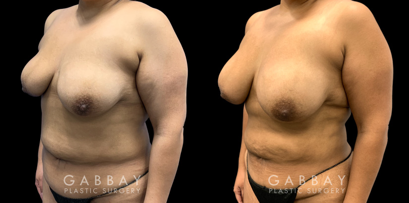 Patient 15 3/4th Left Side View Breast Fat Grafting Gabbay Plastic Surgery