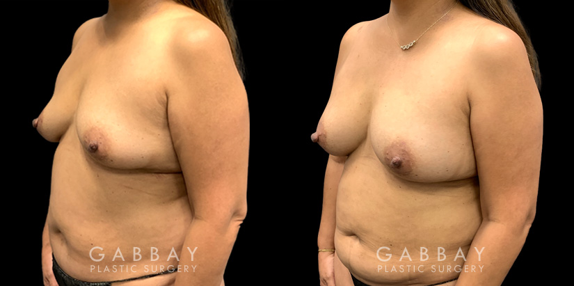 Patient 16 3/4th Left Side View Breast Fat Grafting Gabbay Plastic Surgery