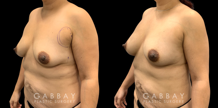 Patient 17 3/4th Left Side View Breast Fat Grafting Gabbay Plastic Surgery