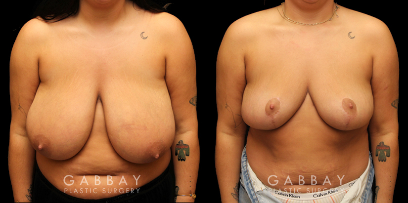 Patient 02 Front View Breast Reduction with Lift Gabbay Plastic Surgery