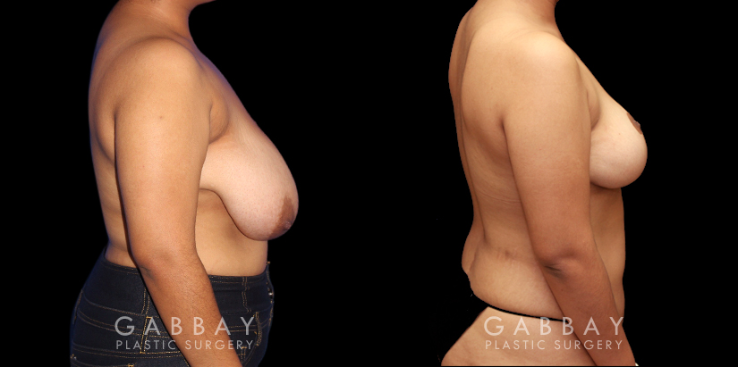 Patient 03 Right Side View Mastopexy Gabbay Plastic Surgery