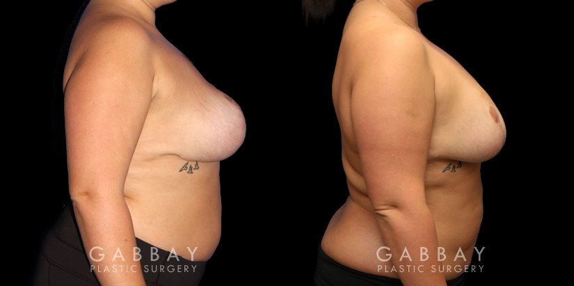 Patient 03 Right Side View Revision Breast Reduction, Revision Wide Mastopext, Belladerm Gabbay Plastic Surgery