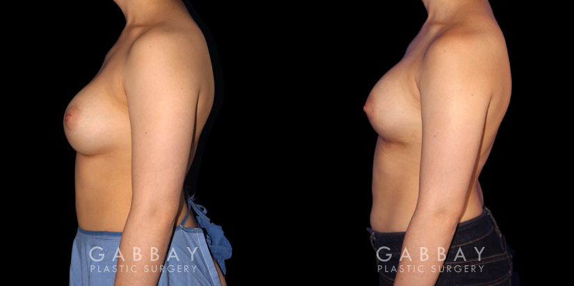 Patient 06 Left Side View Breast Augmentation-Remove and Replace Saline & Full Lift Gabbay Plastic Surgery