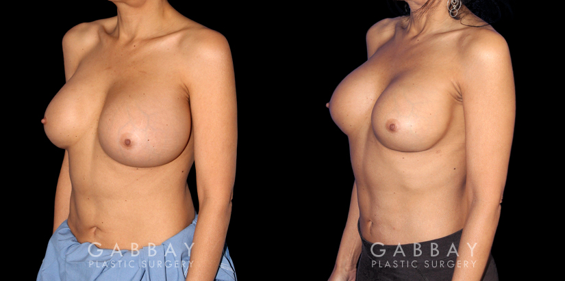 Patient 07 3/4th Left Side View Breast Revision Gabbay Plastic Surgery