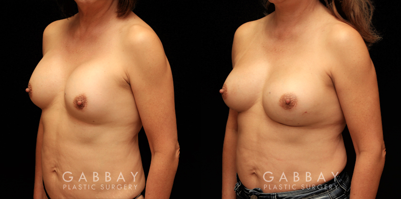 Patient 16 3/4th Left Side View Removal and Replacement Gabbay Plastic Surgery