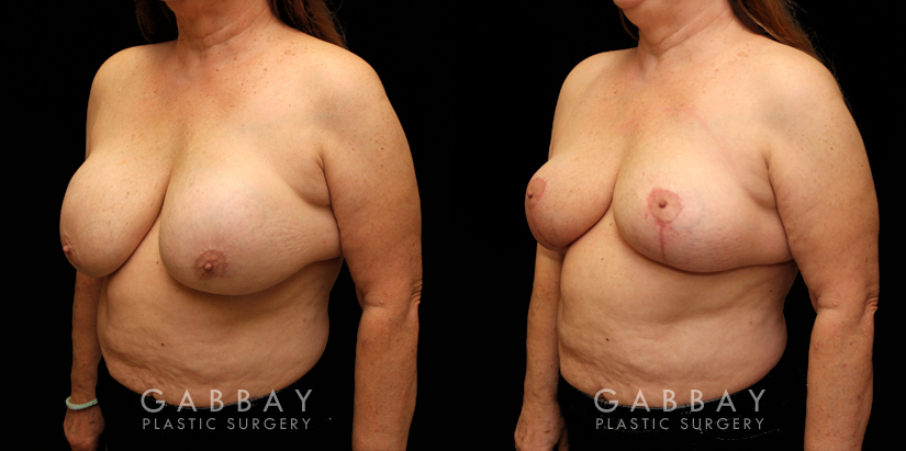 Patient 17 3/4th Left Side View Implant Removal and Lift Gabbay Plastic Surgery