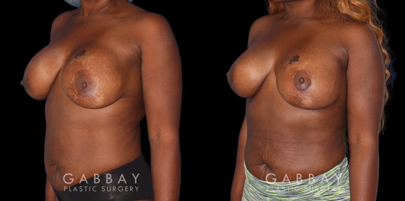 Patient 18 3/4th Left Side View Breast Revision Gabbay Plastic Surgery