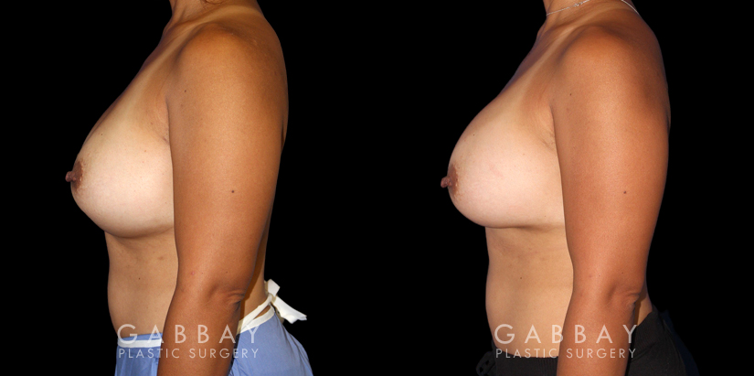 Patient 19 Left Side View Breast Revision Gabbay Plastic Surgery