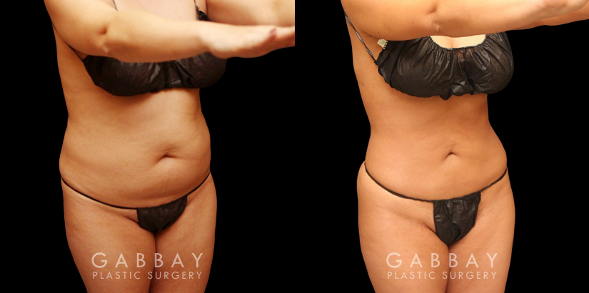 Female liposuction results with significant fat reduction in the abdomen for a tighter appearance while maintaining a natural-looking body contour. Patient recovered quickly and without complications.