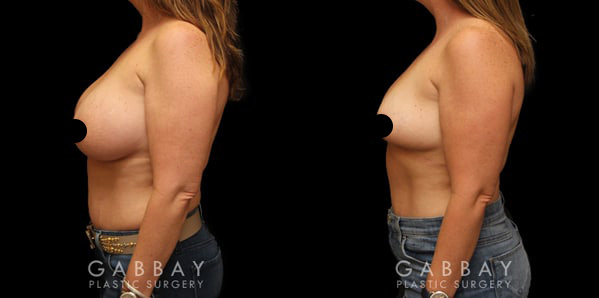 Patient 01 Front View Breast Implant Removal Before and After Gabbay Plastic Surgery