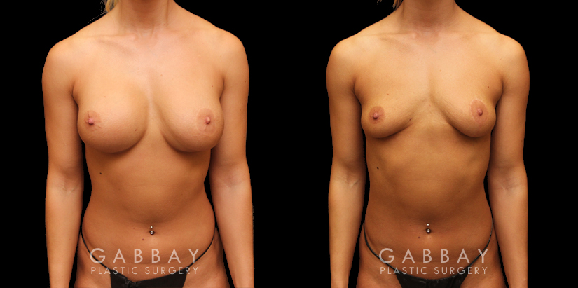 Patient 03 Front View Implant Removal/Mastopexy/Auto Augmentation Gabbay Plastic Surgery