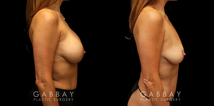 Patient 07 Right Side View Mini Tummy Tuck and Lipo to Waist Gabbay Plastic Surgery