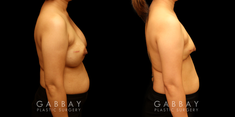 Patient 09 Right Side View Breast Implant Removal and Lift Gabbay Plastic Surgery