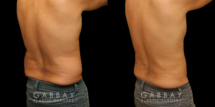 Male liposuction results after reducing stubborn belly fat that would not respond to diet or exercise. The belly area went from significant overhang above the beltline to a flatter contour.