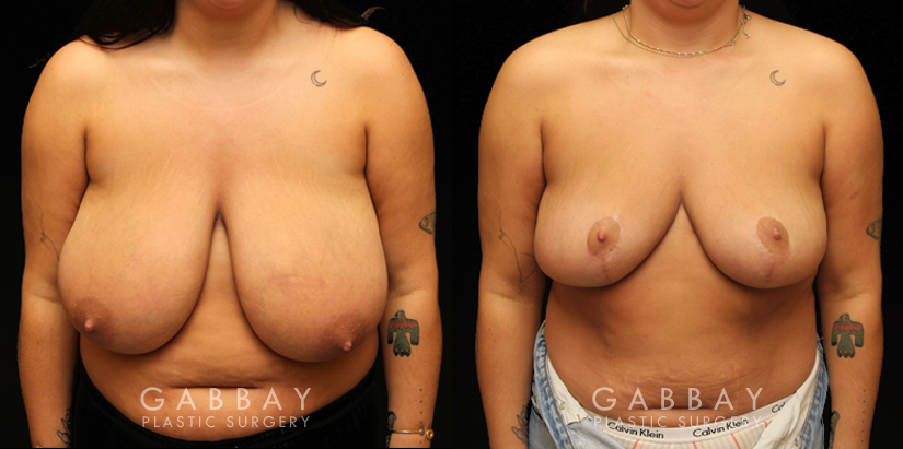 Breast reduction with lift