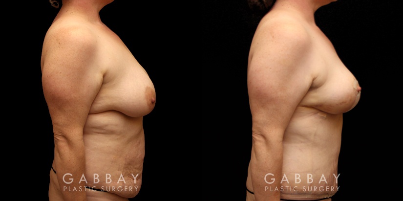 Patient 11 Right Side View Tummy Tuck and Breast Lift Gabbay Plastic Surgery