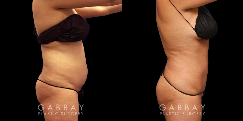 Results of a safe abdominal liposuction surgery that provided this female patient with notable slimming. Note the flat stomach from the profile view with no overhang above the waistline.