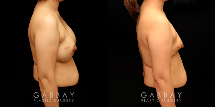 Patient 13 Right Side View Breast Implant Removal and Lift Gabbay Plastic Surgery