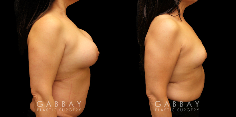 Patient 14 Right Side View Auto Augmentation with Lift Gabbay Plastic Surgery