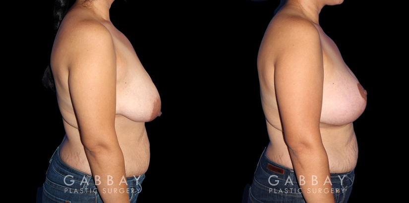 Patient 18 Right Side View Breast Augmentation Silicone, Mastopexy Gabbay Plastic Surgery
