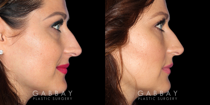 Patient 01 Right Side View Upper Eyelid Blepharoplasty with Fat Transfer to Face Gabbay Plastic Surgery