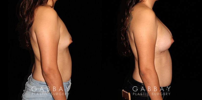 Patient 22 Right Side View Breast Augmentation with Lift to Right Breast Gabbay Plastic Surgery