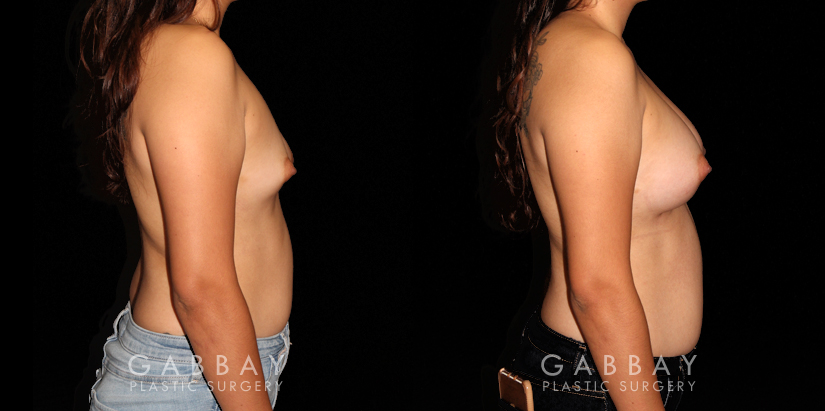 Breast Augmentation with Lift to Right Breast