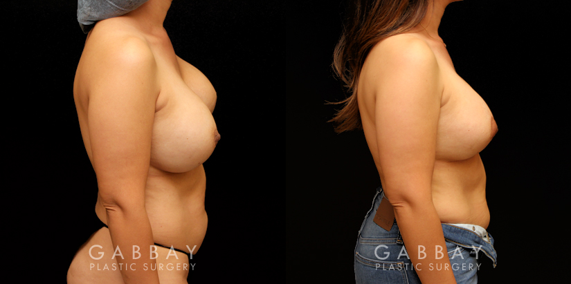 Patient 23 Right Side View Removal and Replacement with Lift Silicone Gabbay Plastic Surgery