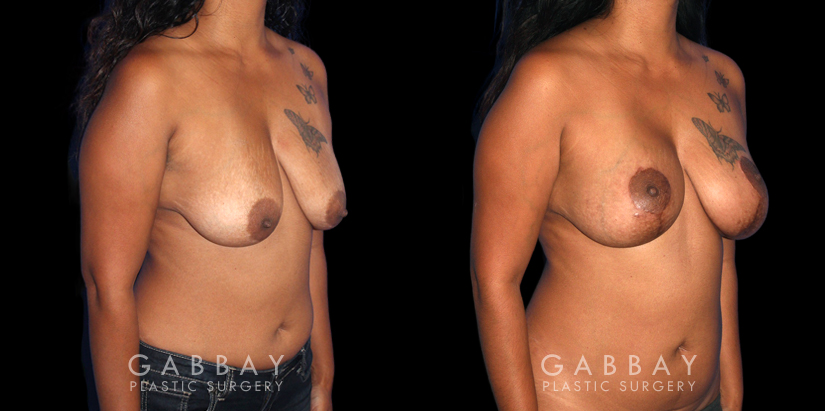 Patient 25 3/4th Right Side View Wise Mastopexy with Silicone Breast Implants Gabbay Plastic Surgery