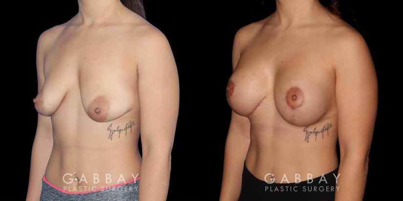 Breast Augmentation w/ Mastopexy – Silicone