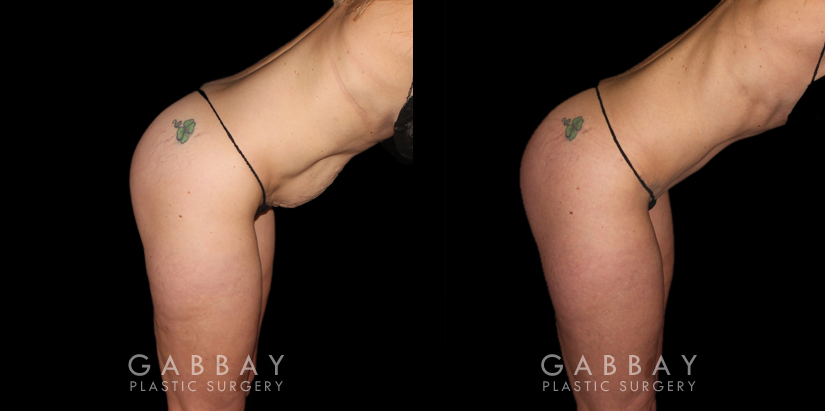Patient results from tummy tuck. Note before the loose, hanging area at the lower abdomen. Following fat removal and abdominal tightening, the patient achieved a slim, refined silhouette.