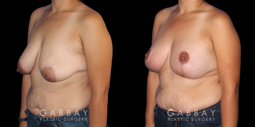 Breast Augmentation – Silicone, Mastopexy