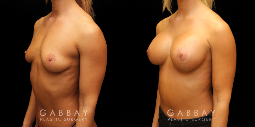 Patient 08 3/4th Left Side View Implants repeal & replacement (left) Gabbay Plastic Surgery