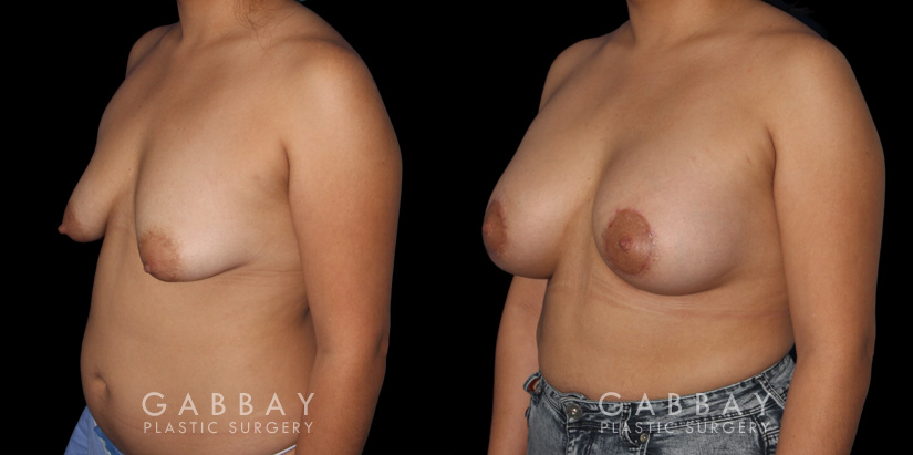 Breast Augmentation – Silicone & Lift