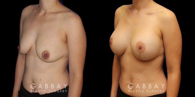 Scar revision to breasts results with additional breast augmentation and lift combination. Patient improved breast size and position with mild scarring only.