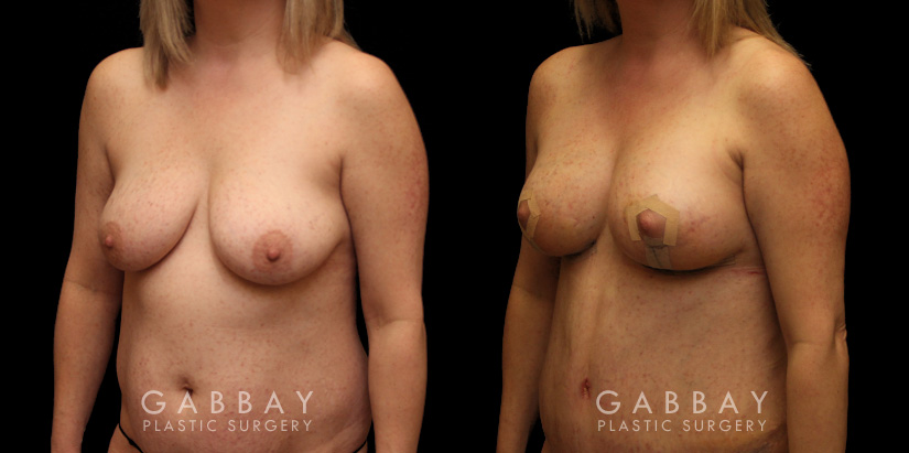 Patient 20 3/4th Left Side View Breast aug/pexy and tummy tuck Gabbay Plastic Surgery