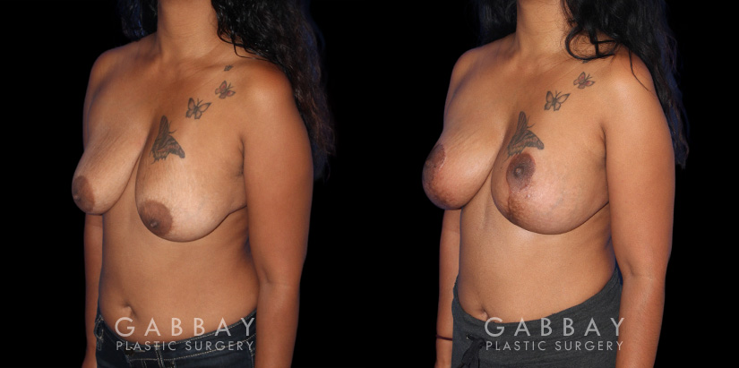 Patient 21 3/4th Left Side Wise Mastopexy with Silicone Breast Implants Gabbay Plastic Surgery