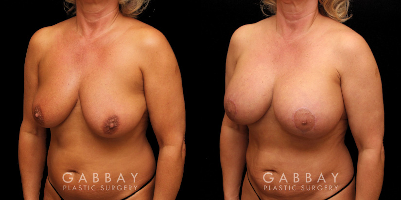 Breast Aug/Pexy with Liposcution and J-plasma to the Full Abdomen and Upper Back Bra Roll