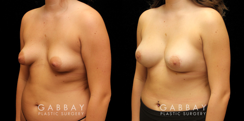 Patient 11 3/4th Left Side View Augpexy Gabbay Plastic Surgery