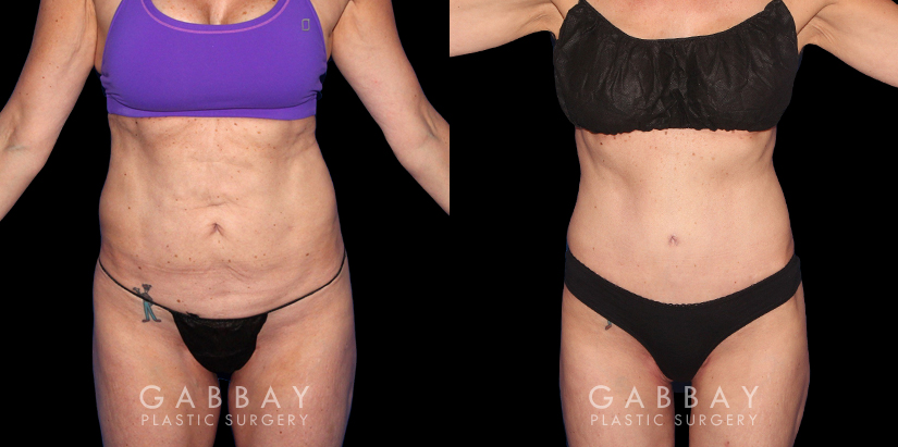 Before and after photos for body procedures, including a tummy tuck and inner thigh liposuction. Combining the procedures resulted in a flatter, smoother abdomen balanced with subtle yet effective tightening of the thighs. The final result evokes a more youthful contour.